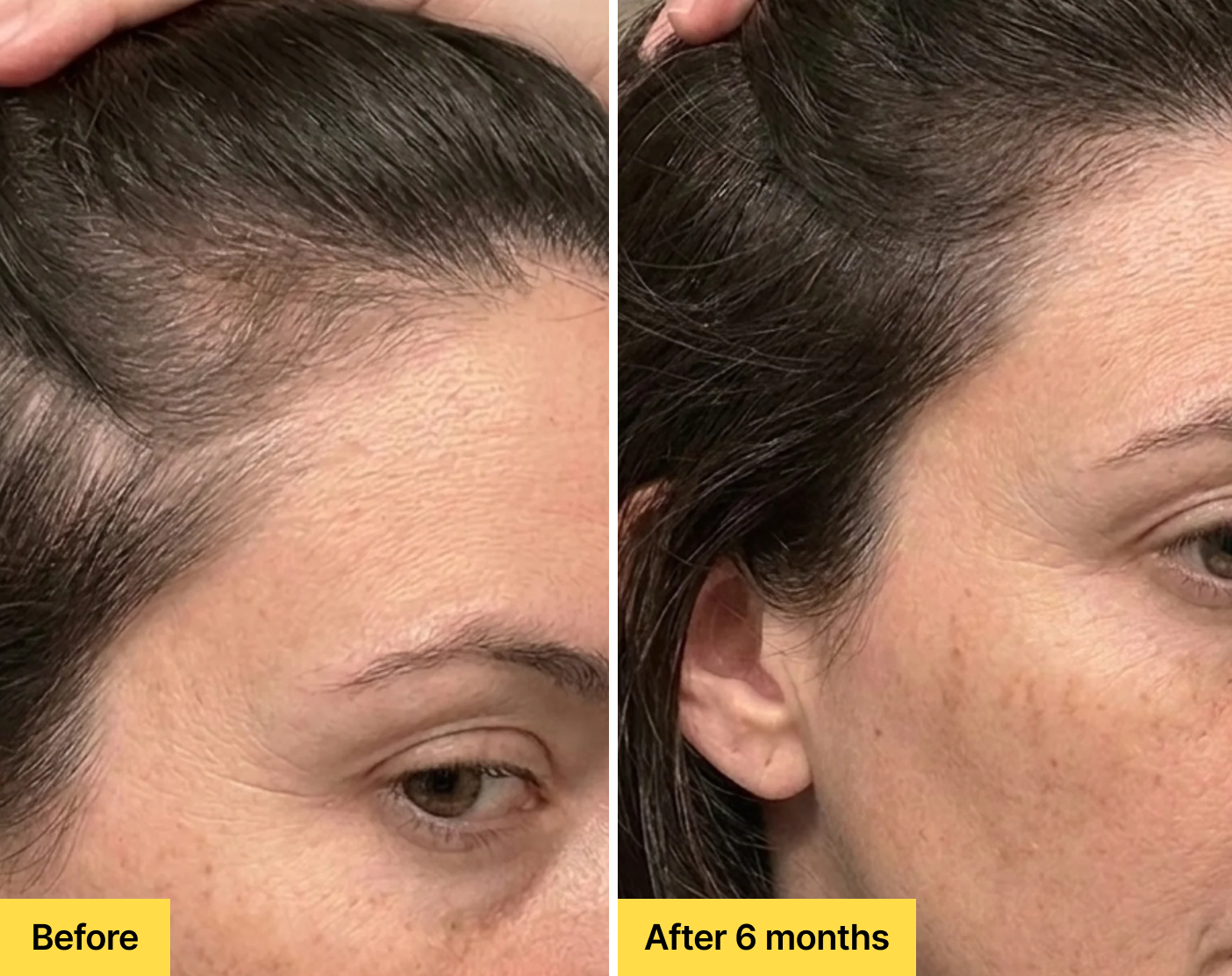 Hair Thinning vs Hair Loss: How to Tell the Difference and What to Do Next