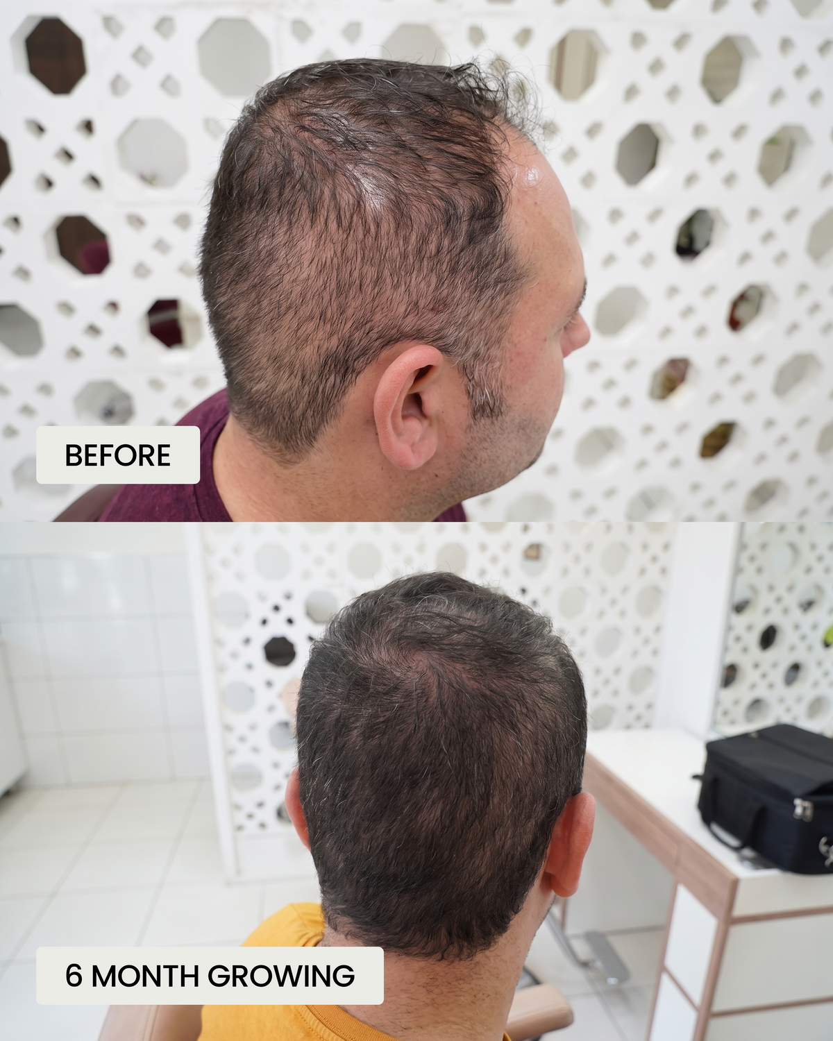 Hair growth supplements for men: what to look for, what to expect and when they help