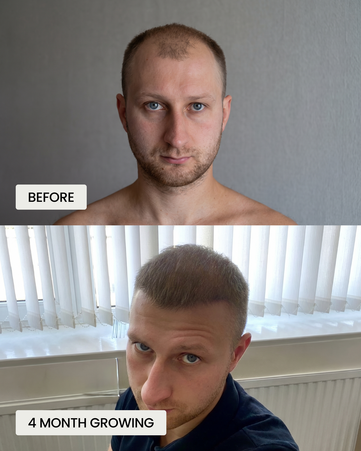 Zinc for Hair Loss in Men: Does It Work or Is DHT the Real Cause?