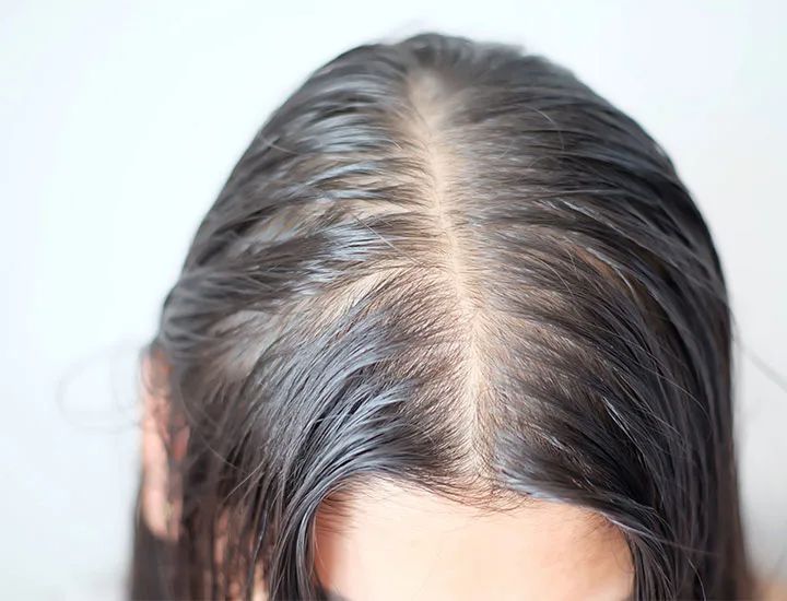 How DHT Causes Hair Loss: What It Does to Follicles, Who It Affects, and What May Help