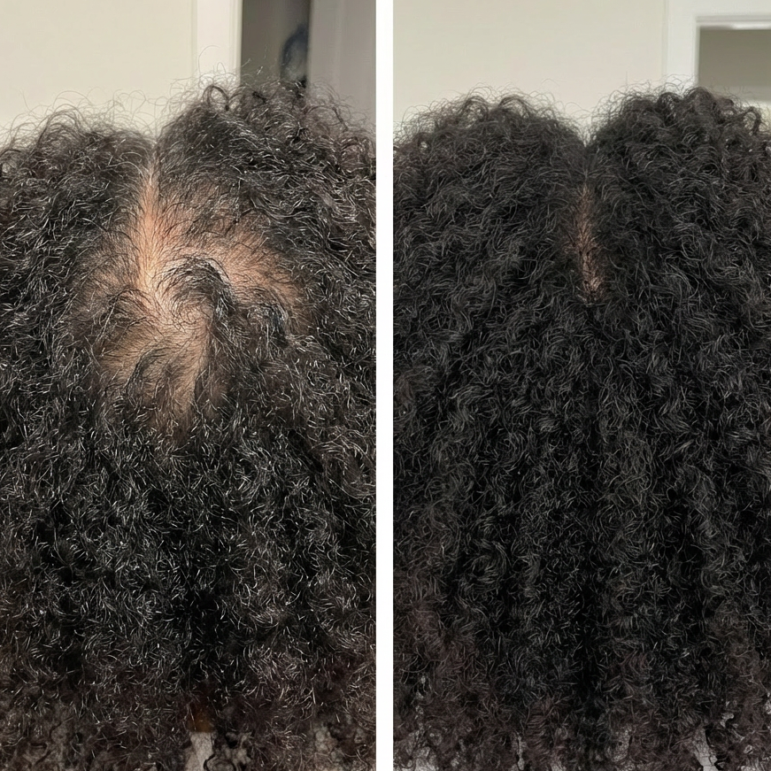 Before and after: crown of curly dark hair, thinner on the left, fuller on the right